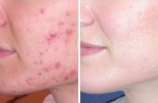 Q and A for Severe Acne Treatment