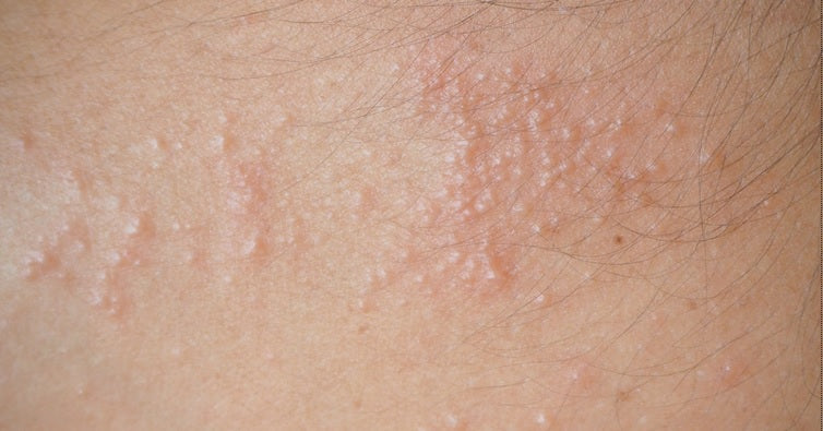 Sauna Rash How to Treat Heat Rash and sunburn – gelmersea