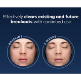 PCA SKIN Acne Gel, 2% Salicylic Acid Face and Spot Treatment, 1 Fl Oz